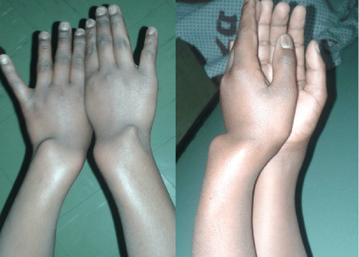 WRIST DEFORMITY